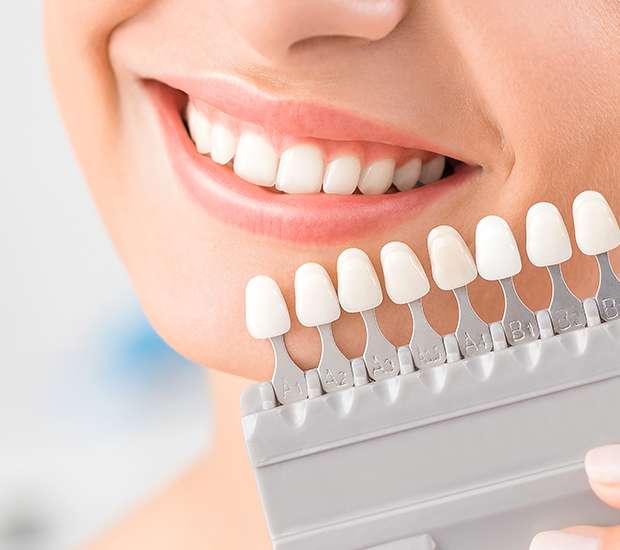 Temecula Dental Veneers and Dental Laminates